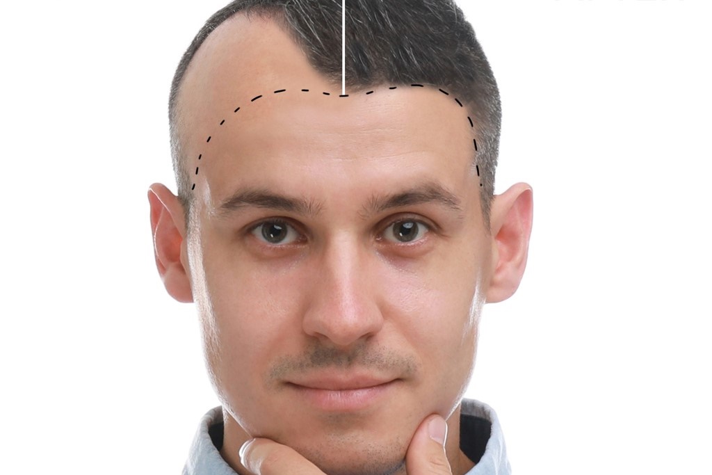 HAIR TRANSPLANT